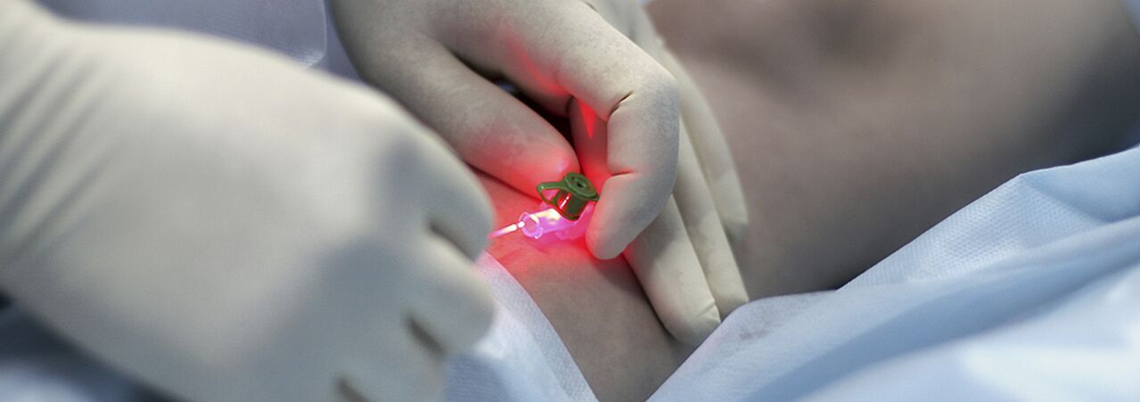 Compression sclerotherapy